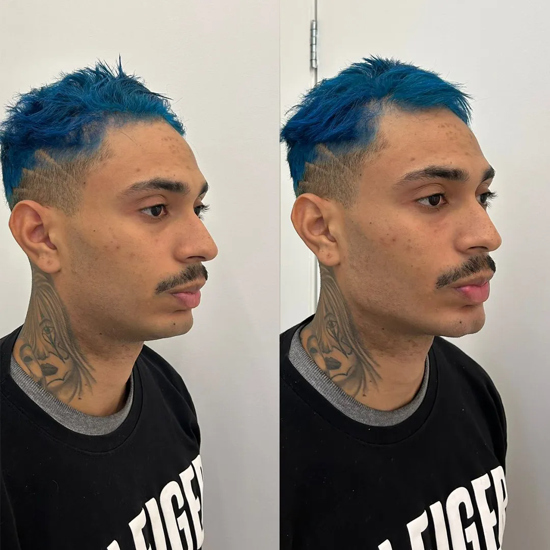 Harmonização Orofacial